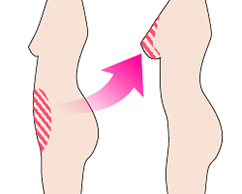 Lipotransfer 2